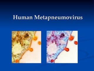 Human Metapneumovirus
 