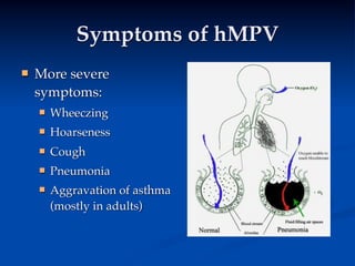 Symptoms of hMPV
   More severe
    symptoms:
       Wheeczing
       Hoarseness
       Cough
       Pneumonia
       Aggravation of asthma
        (mostly in adults)
 
