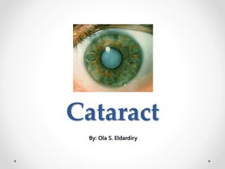 Cataract
By: Ola S. Eldardiry
 