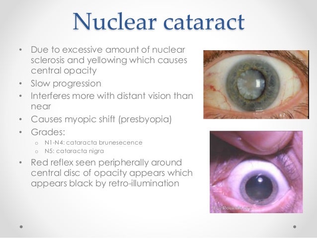 Cataract