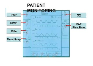 Bi pap -ppt | PPTX