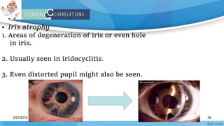 Real Anatomy of UVEA. | PPTX