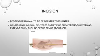 BIPOLAR HEMIARTHROPLASTY (1).pptx