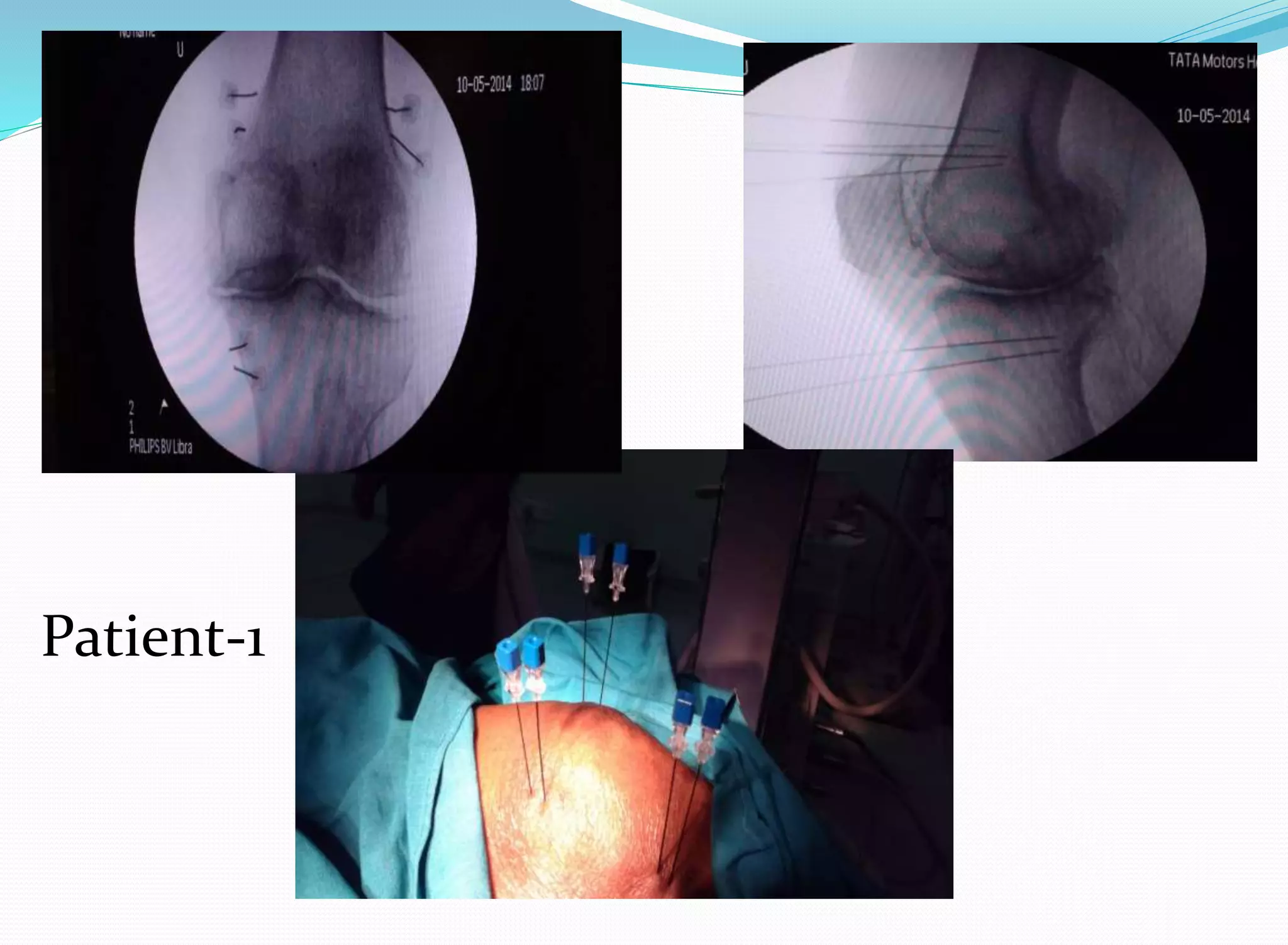 Bipolar RFA knee in Patients with Pacemaker | PPTX