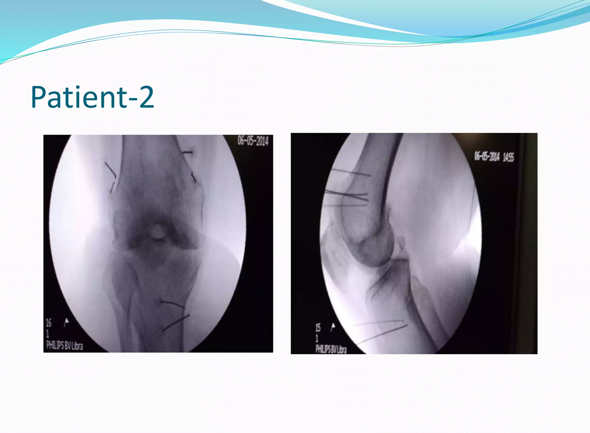 Bipolar RFA knee in Patients with Pacemaker | PPTX