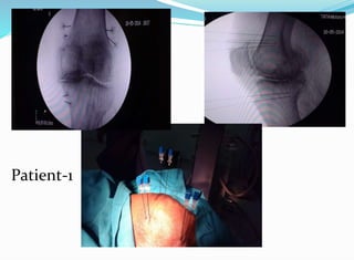 Bipolar RFA knee in Patients with Pacemaker | PPTX
