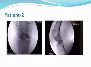 Bipolar RFA knee in Patients with Pacemaker | PPTX