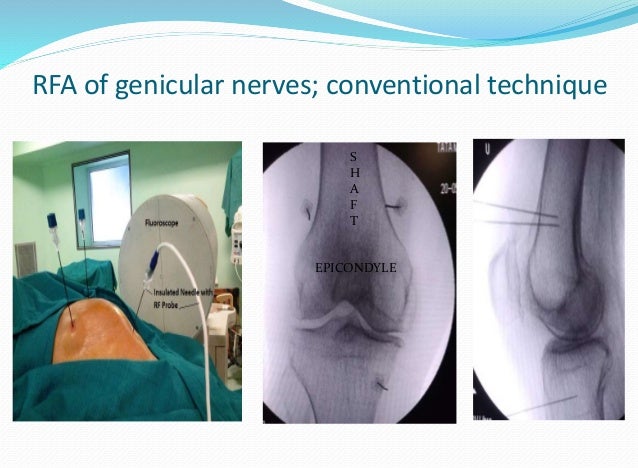 Bipolar RFA knee in Patients with Pacemaker