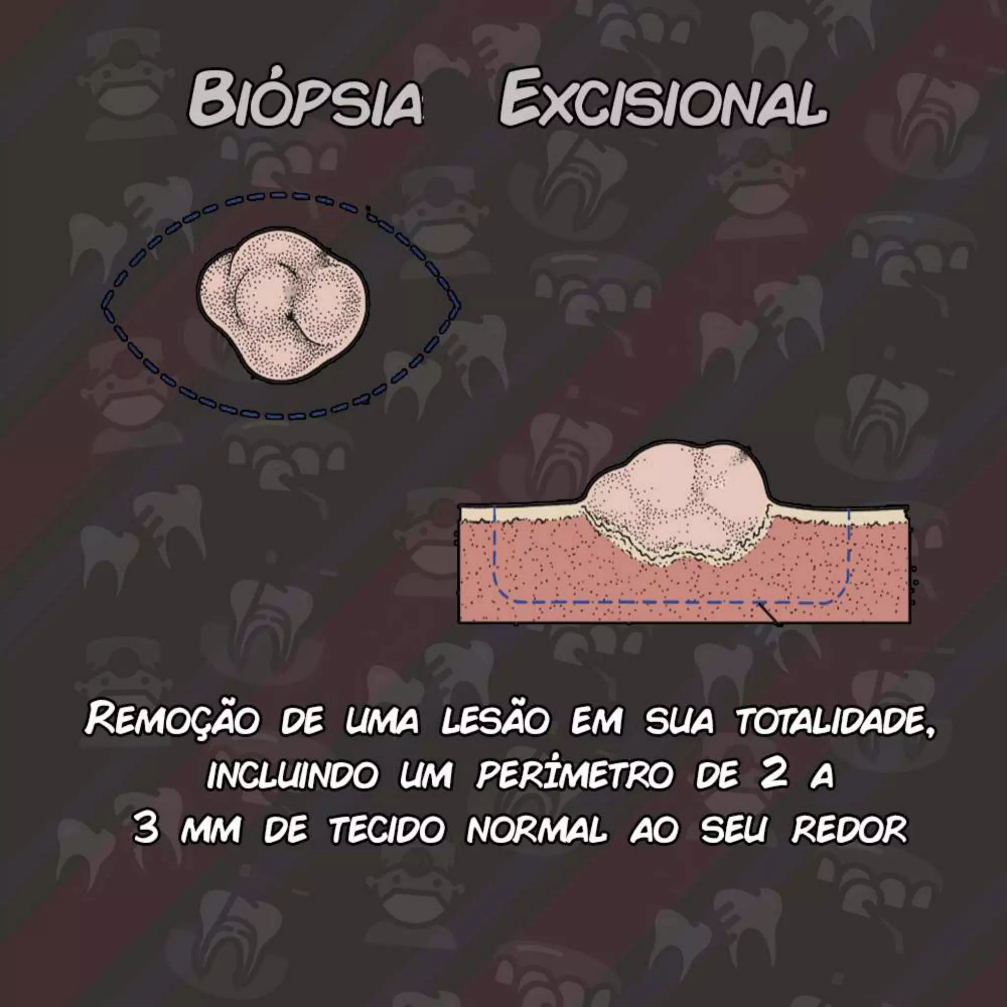 Biópsias em Odontologia - Incisional, Excisional, Punch, Citologia ...