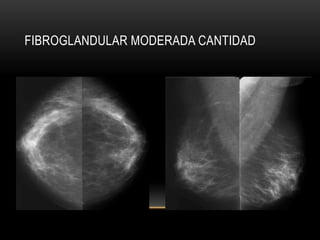 FIBROGLANDULAR MODERADA CANTIDAD
 