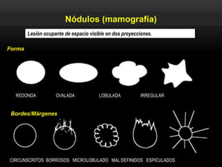 Forma
REDONDA OVALADA LOBULADA IRREGULAR
CIRCUNSCRITOS BORROSOS MICROLOBULADO MAL DEFINIDOS ESPICULADOS
Bordes/Márgenes
Lesión ocupante de espacio visible en dos proyecciones.
Nódulos (mamografía)
 