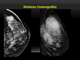 Nódulos (mamografía)
 