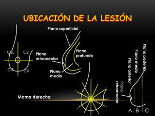CSE CSI
CIICIE
Plano superficial
Plano
medio
Plano
profundoPlano
retroareolar
12
1
2
3
4
8
9
10
11
Planomedio
Planoanterior
Planoposterior
Plano
retroareolar
A B C
Mama derecha
UBICACIÓN DE LA LESIÓN
 