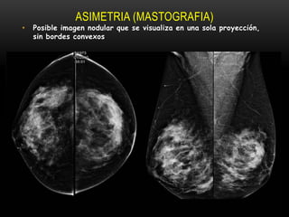 ASIMETRIA (MASTOGRAFIA)
• Posible imagen nodular que se visualiza en una sola proyección,
sin bordes convexos
 