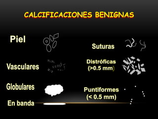 CALCIFICACIONES BENIGNAS
 