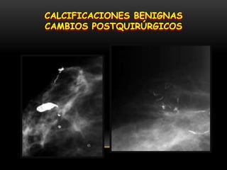 CALCIFICACIONES BENIGNAS
CAMBIOS POSTQUIRÚRGICOS
 