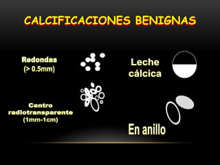 CALCIFICACIONES BENIGNAS
 