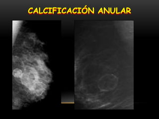 CALCIFICACIÓN ANULAR
 