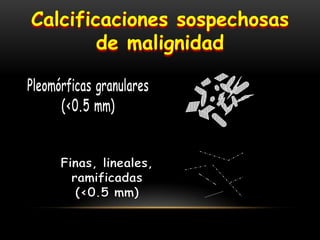 Calcificaciones sospechosas
de malignidad
 