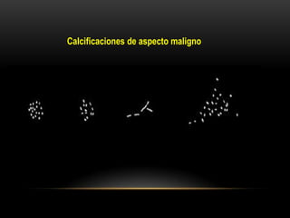 Calcificaciones de aspecto maligno
 