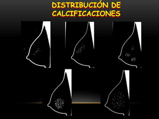 DISTRIBUCIÓN DE
CALCIFICACIONES
 