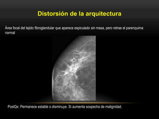 Área focal del tejido fibroglandular que aparece espiculado sin masa, pero retrae el parenquima
normal
PostQx: Permanece estable o disminuye. Si aumenta sospecha de malignidad.
Distorsión de la arquitectura
 