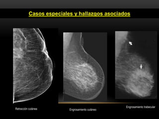 Casos especiales y hallazgos asociados
Engrosamiento trabecular
Retracción cutánea Engrosamiento cutáneo
 