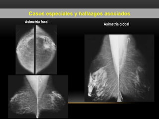 Casos especiales y hallazgos asociados
Asimetría global
Asimetría focal
 