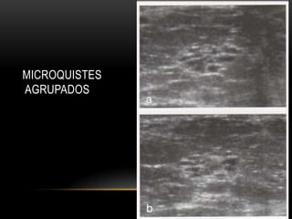 MICROQUISTES
AGRUPADOS
 