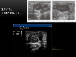 QUISTES
COMPLICADOS
 