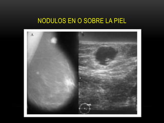 NODULOS EN O SOBRE LA PIEL
 