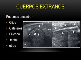 CUERPOS EXTRAÑOS
Podemos encontrar:
• Clips
• Catéteres
• Silicona
• metal
• otros
 