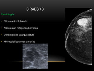 BIRADS 4B
Semiología:
• Nódulo microlobulado
• Nódulo con márgenes borrosos
• Distorsión de la arquitectura
• Microcalcificaciones amorfas
 