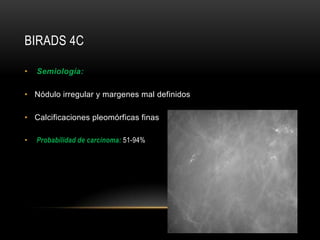 BIRADS 4C
• Semiología:
• Nódulo irregular y margenes mal definidos
• Calcificaciones pleomórficas finas
• Probabilidad de carcinoma: 51-94%
 