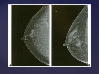 Padrão mamográficoPadrão mamográfico
 