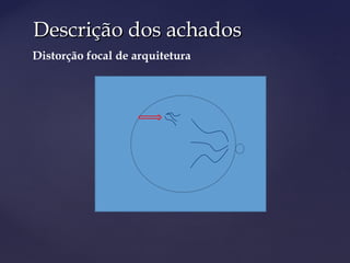 Descrição dos achadosDescrição dos achados
Distorção focal de arquitetura
 