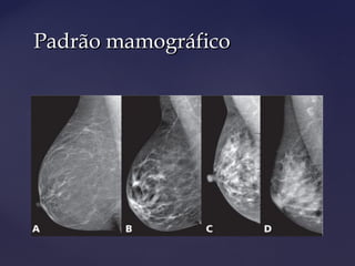 Padrão mamográficoPadrão mamográfico
 