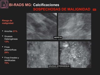 BI-RADS MG: Calcificaciones
SOSPECHOSAS DE MALIGNIDAD
Riesgo de
malignidad:
• Amorfas 21%
• Gruesas
Heterogéneas
13%
• Fin...