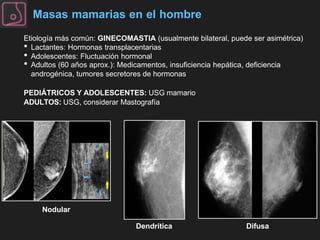 Masas mamarias en el hombre
Etiología más común: GINECOMASTIA (usualmente bilateral, puede ser asimétrica)
• Lactantes: Ho...
