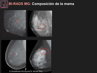 BI-RADS MG: Composición de la mama
 