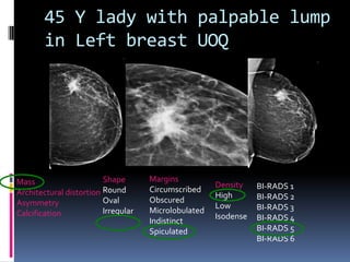 45 Y lady with palpable lump
in Left breast UOQ
Mass
Architectural distortion
Asymmetry
Calcification
Shape
Round
Oval
Irregular
Margins
Circumscribed
Obscured
Microlobulated
Indistinct
Spiculated
Density
High
Low
Isodense
BI-RADS 1
BI-RADS 2
BI-RADS 3
BI-RADS 4
BI-RADS 5
BI-RADS 6
 