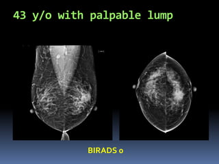 43 y/o with palpable lump
BIRADS 0
 
