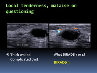 Local tenderness, malaise on
questioning
 Thick walled
Complicated cyst
BIRADS 3
What BIRADS 3 or 4?
 