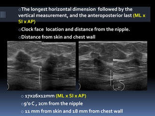 oThe longest horizontal dimension followed by the
vertical measurement, and the anteroposterior last (ML x
SI x AP)
oClock face location and distance from the nipple.
oDistance from skin and chest wall
o 17x26x12mm (ML x SI x AP)
o9’0 C , 2cm from the nipple
o 11 mm from skin and 18 mm from chest wall
 