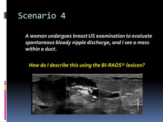 Scenario 4
A woman undergoes breast US examination to evaluate
spontaneous bloody nipple discharge, and I see a mass
within a duct.
How do I describe this using the BI-RADS® lexicon?
 
