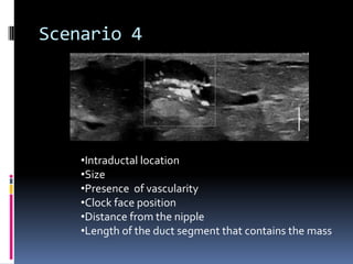 Scenario 4
•Intraductal location
•Size
•Presence of vascularity
•Clock face position
•Distance from the nipple
•Length of the duct segment that contains the mass
 