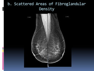 b. Scattered Areas of Fibroglandular
Density
 