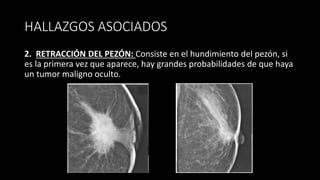 HALLAZGOS ASOCIADOS
2. RETRACCIÓN DEL PEZÓN: Consiste en el hundimiento del pezón, si
es la primera vez que aparece, hay grandes probabilidades de que haya
un tumor maligno oculto.
 