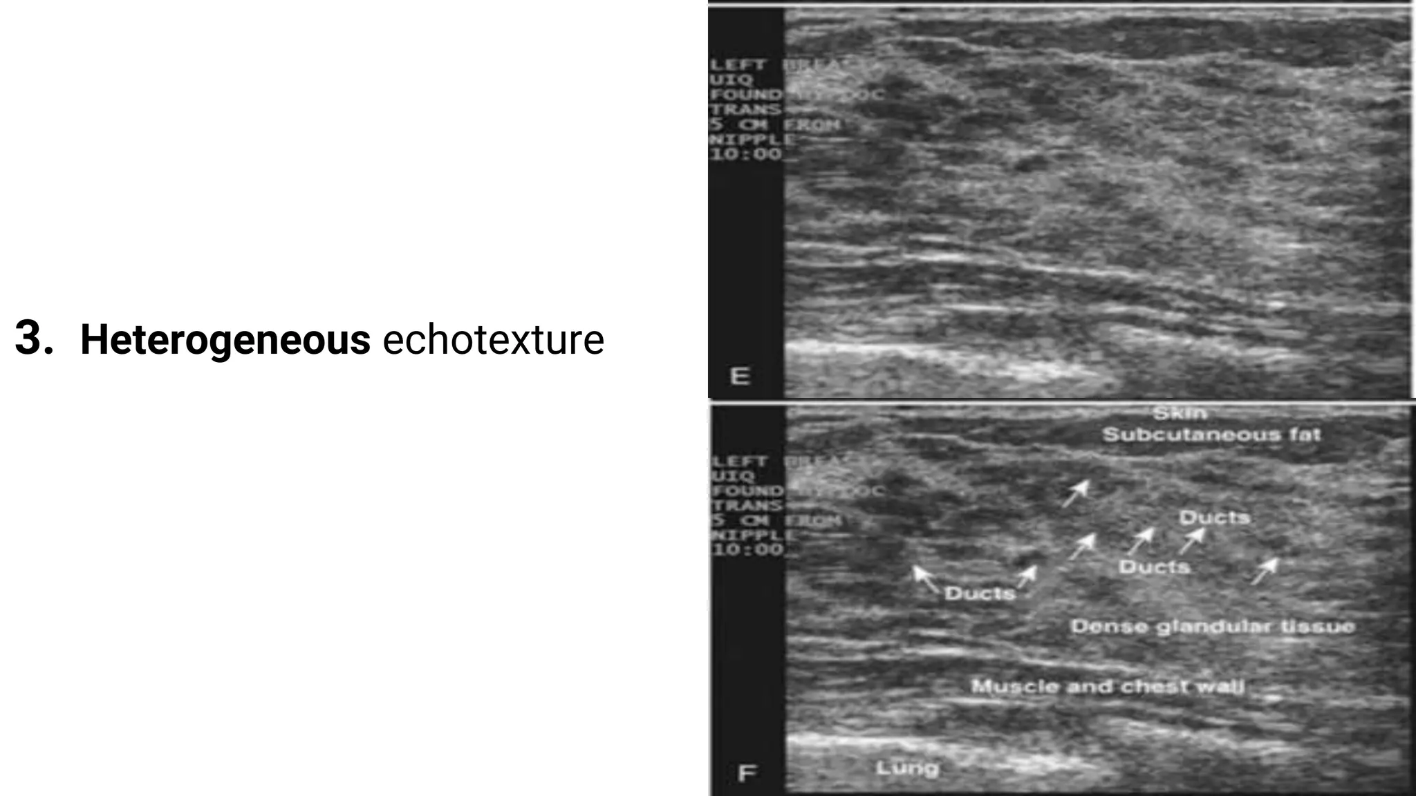 Birads sono-mammography | PPTX