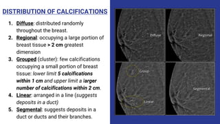 DISTRIBUTION OF CALCIFICATIONS
1. Diffuse: distributed randomly
throughout the breast.
2. Regional: occupying a large portion of
breast tissue > 2 cm greatest
dimension
3. Grouped (cluster): few calcifications
occupying a small portion of breast
tissue: lower limit 5 calcifications
within 1 cm and upper limit a larger
number of calcifications within 2 cm.
4. Linear: arranged in a line (suggests
deposits in a duct)
5. Segmental: suggests deposits in a
duct or ducts and their branches.
 
